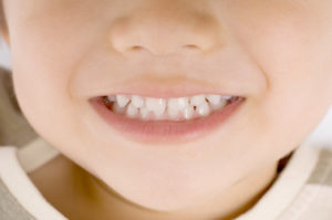 お子さんの矯正治療について